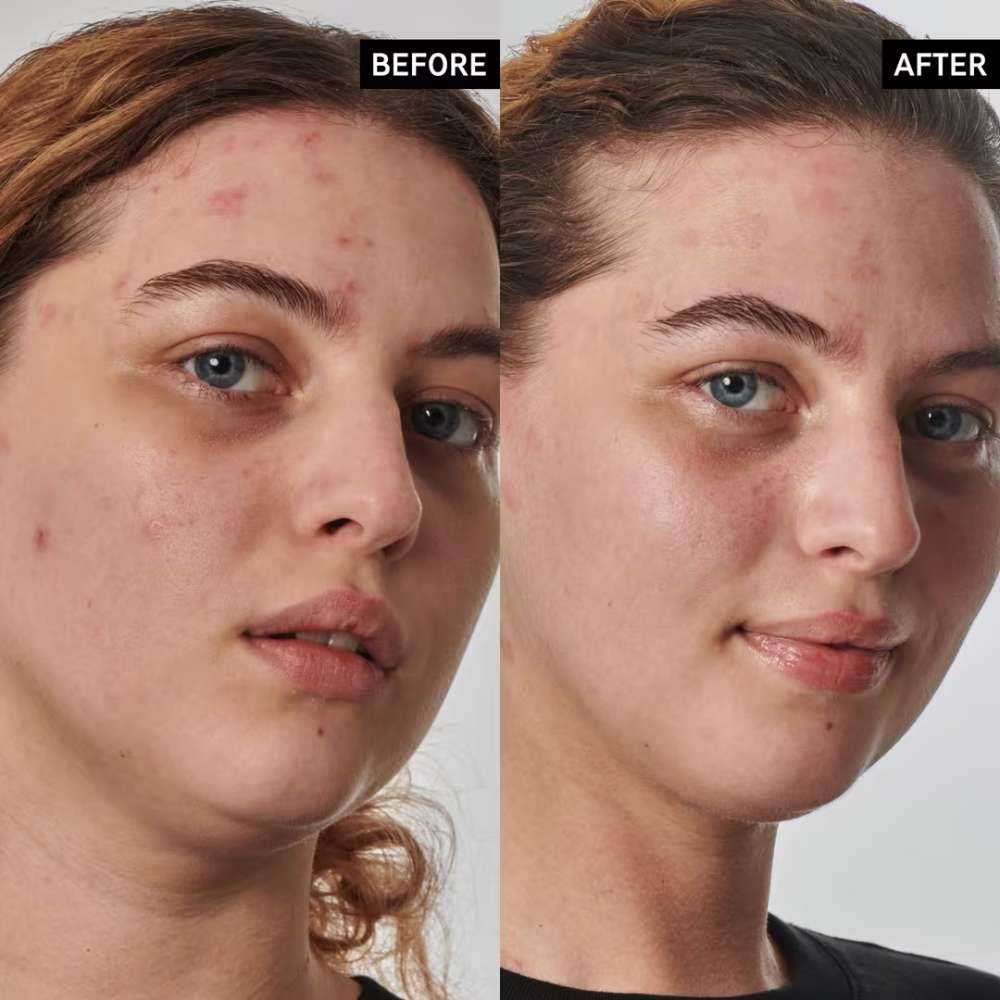The INKEY List SuperSolutions 10% Urea Moisturizer Textured Skin Solution