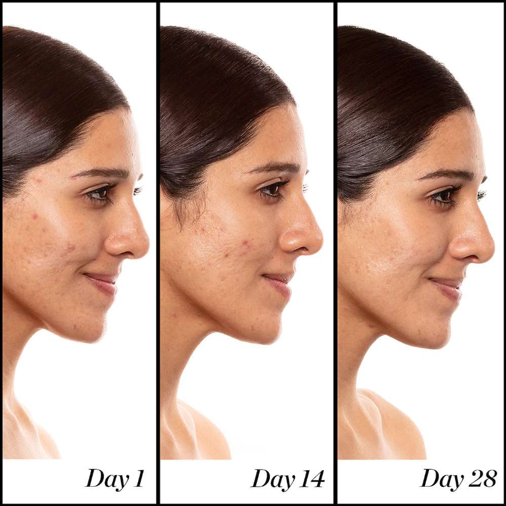 Side-by-side comparison of a woman's face over three days showing skin improvement.