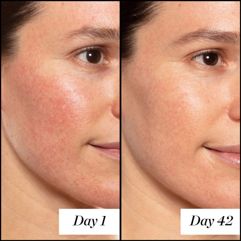 Before and after comparison of a person's face with visible skin improvement over 42 days.