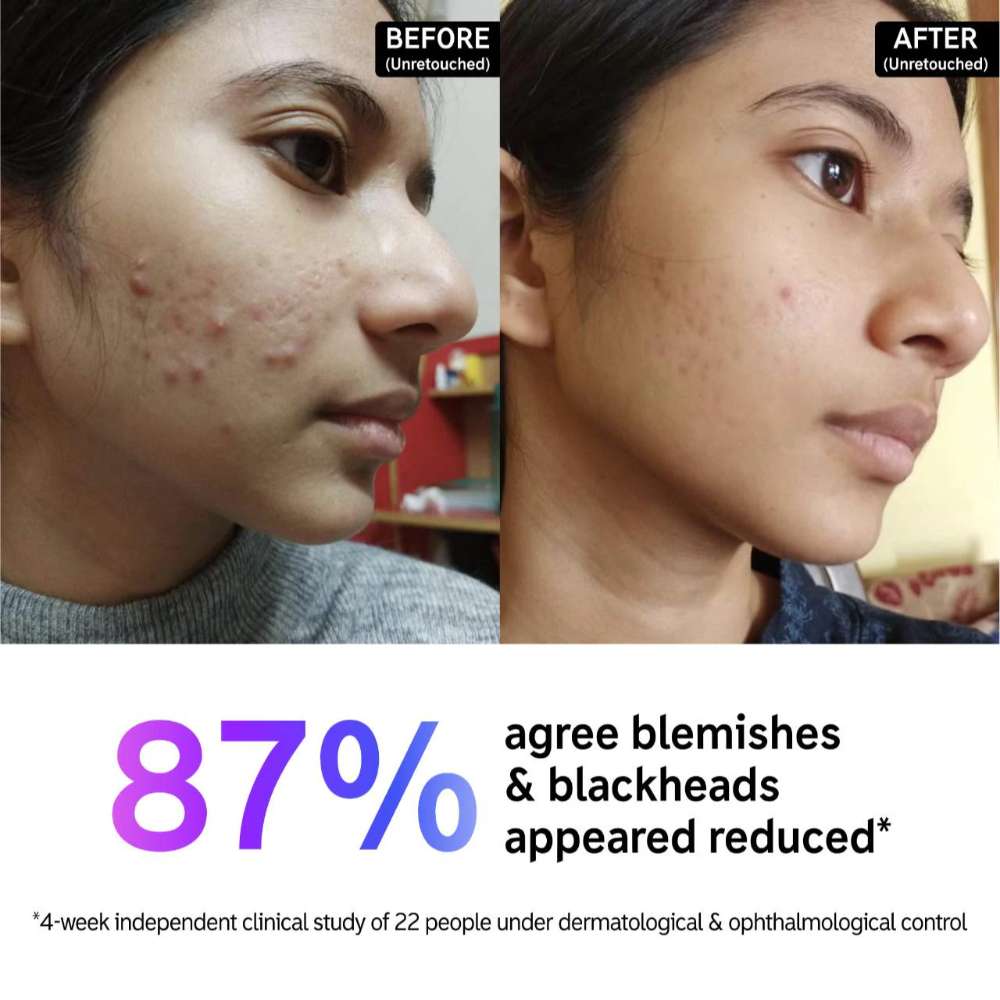 The INKEY List Salicylic Acid Acne + Blackhead Cleanser