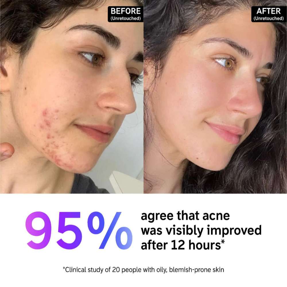 The INKEY List Succinic Acid Acne Treatment