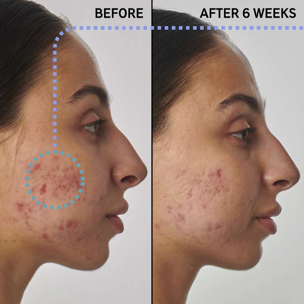 The INKEY List SuperSolutions 1% Retinol Scar, Mark & Wrinkle Solution