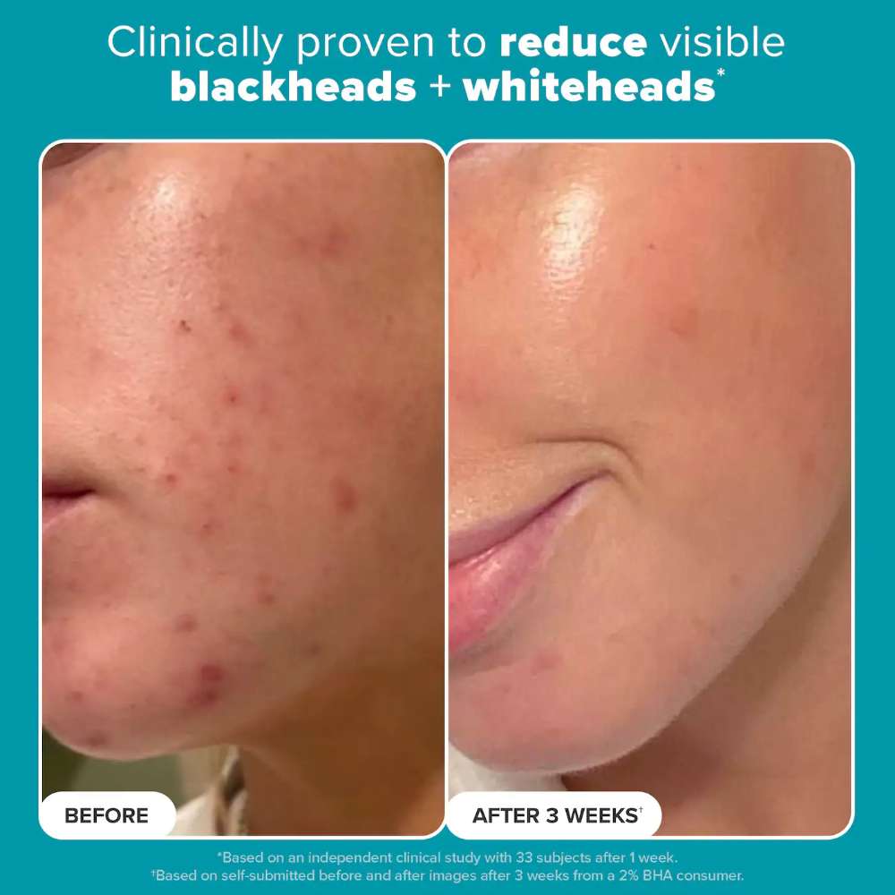 Paula's Choice Skin Perfecting 2% BHA Liquid Exfoliant