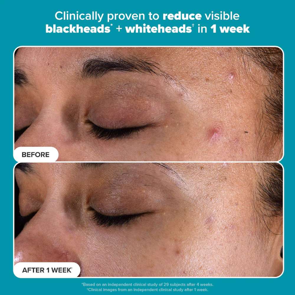 Paula's Choice Skin Perfecting 2% BHA Liquid Exfoliant