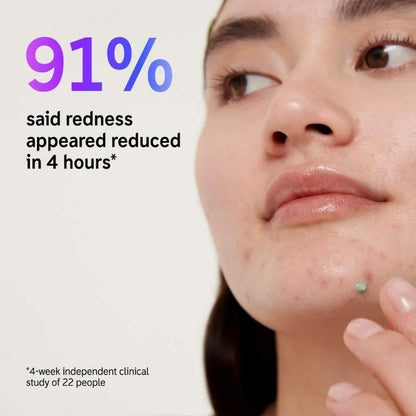 The INKEY List Succinic Acid Acne Treatment