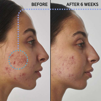 The INKEY List SuperSolutions 1% Retinol Scar, Mark & Wrinkle Solution