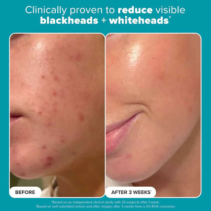 Paula's Choice Skin Perfecting 2% BHA Liquid Exfoliant