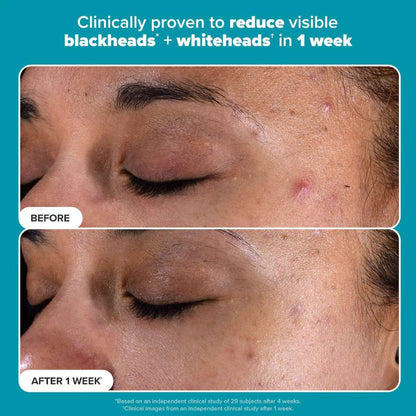 Paula's Choice Skin Perfecting 2% BHA Liquid Exfoliant